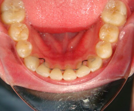Hunter Valley Orthodontics | 464 The Esplanade, Warners Bay NSW 2282, Australia | Phone: 1800 021 064