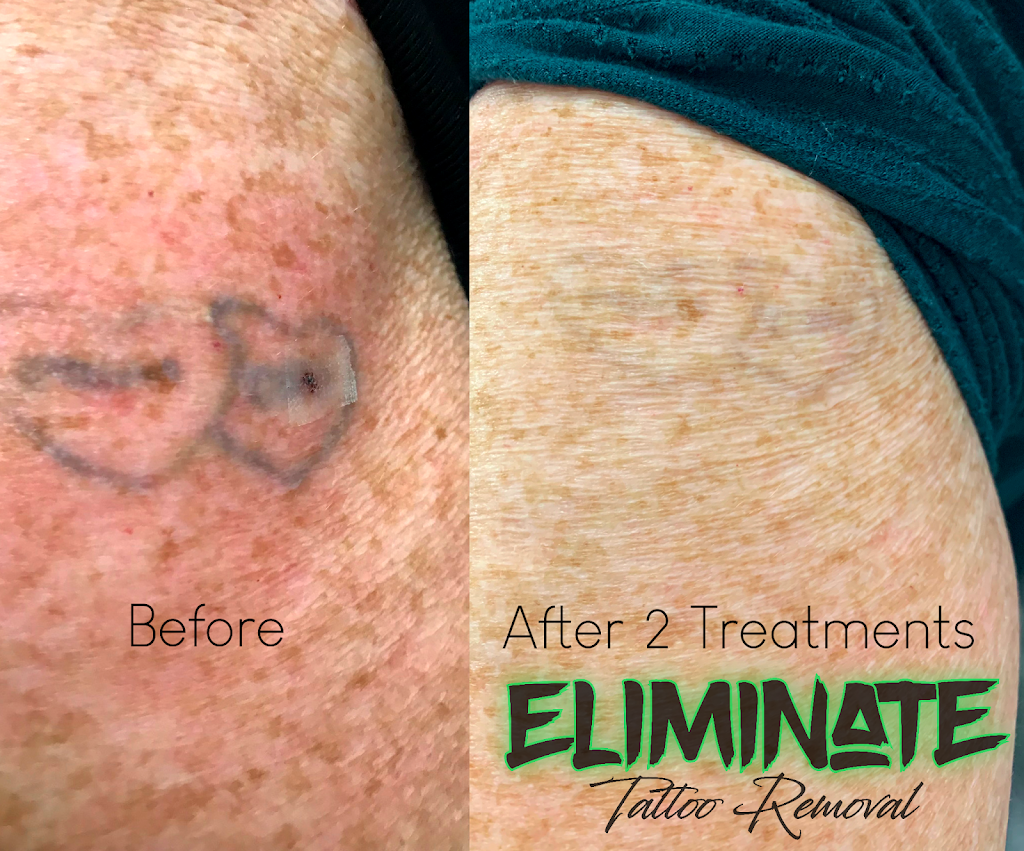 Eliminate Tattoo Removal | 408 Maitland Rd, Mayfield NSW 2304, Australia | Phone: 0403 700 146