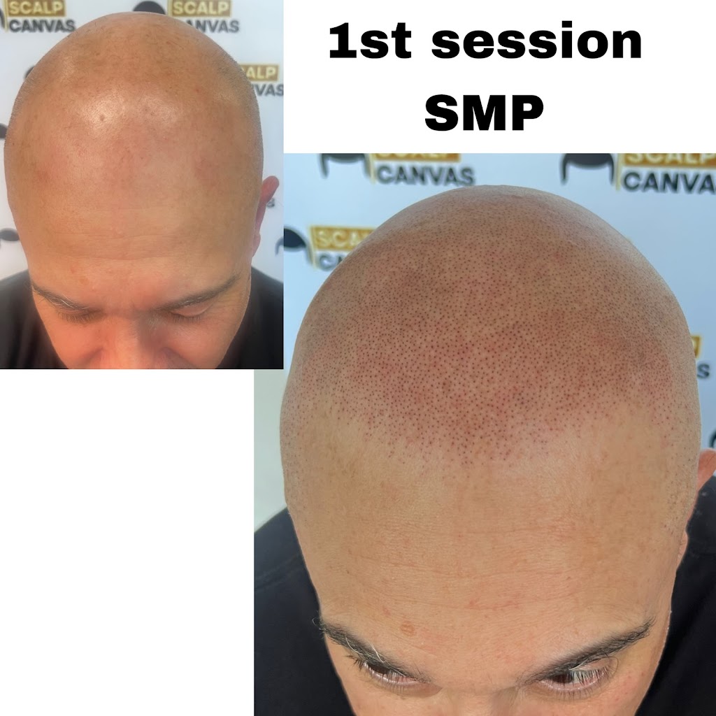 Scalp Canvas - Scalp Micropigmentation Sydney | 1 Inverness Cct, Cecil Hills NSW 2171, Australia | Phone: 0414 400 454