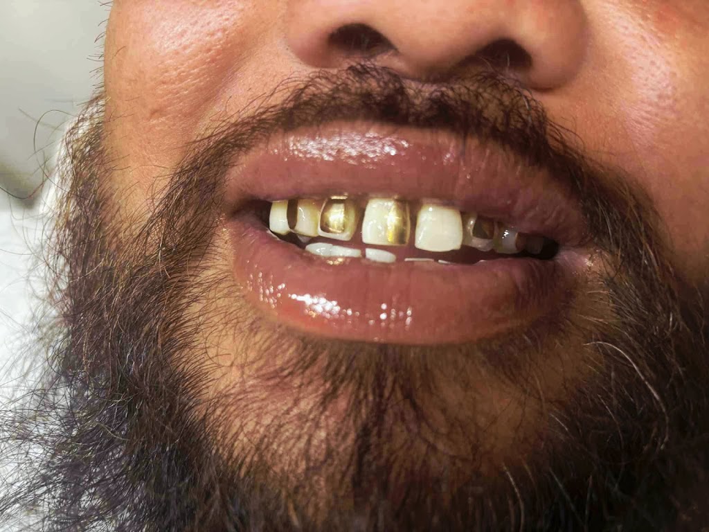 Hibiscus Teeth Whitening | S, 7 Leopard St, Silverdale NSW 2752, Australia | Phone: 0416 817 753