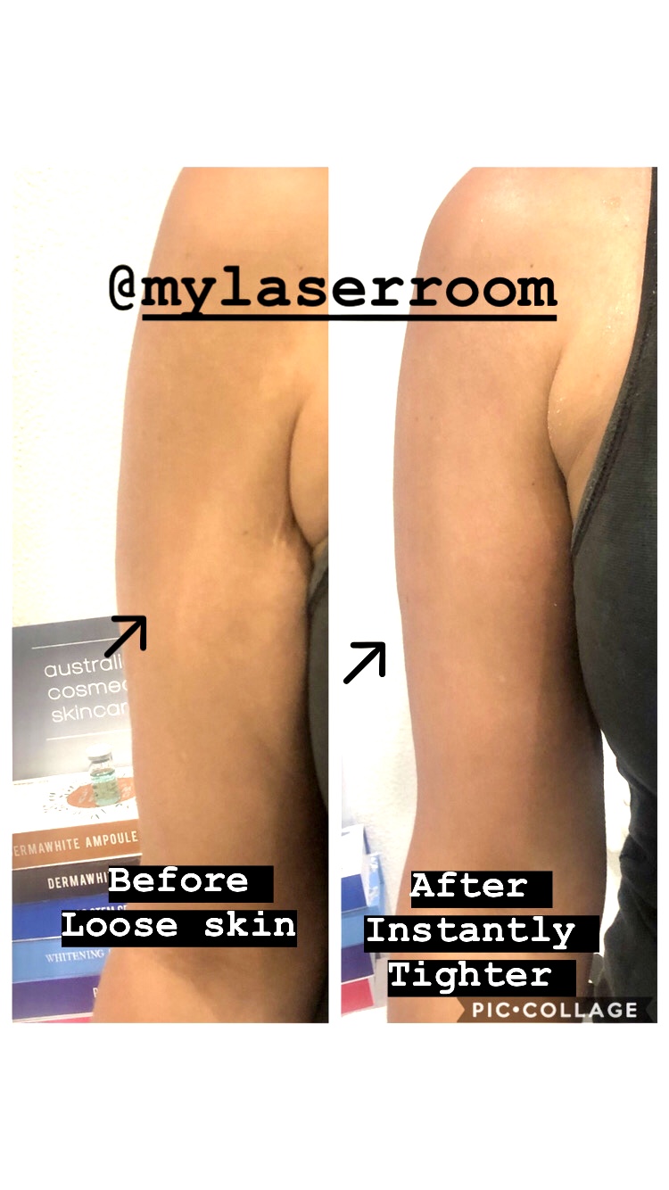 My Laser Room : Beauty salon, body contouring & Skin Needling Me | health | 229 Melville Rd, Pascoe Vale South VIC 3044, Australia | 0420998455 OR +61 420 998 455