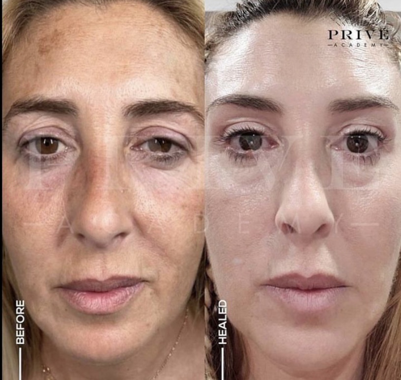 Skin Tightening | 660 The Pocket Rd, The Pocket NSW 2483, Australia | Phone: 0466 899 985