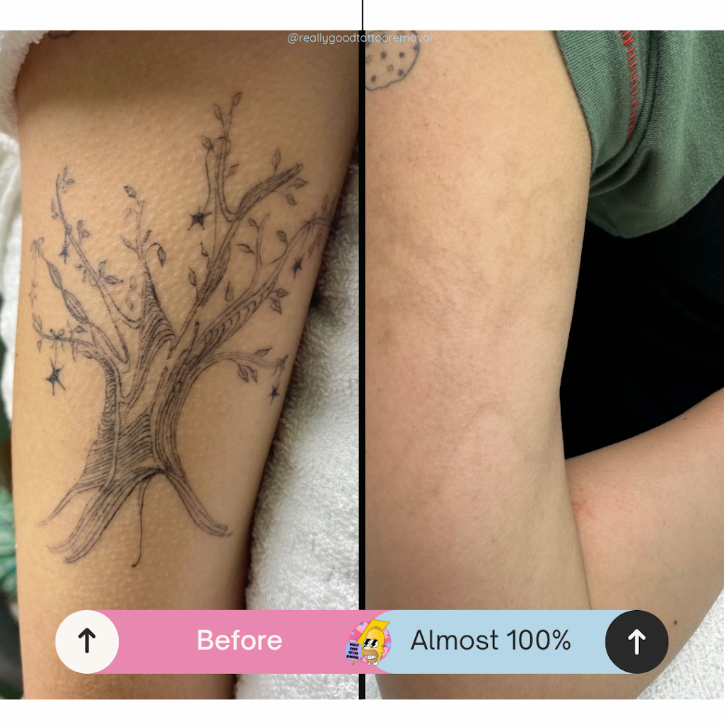 Really Good Tattoo Removal | 47 Clayton St, Sandgate QLD 4017, Australia | Phone: 0413 006 477