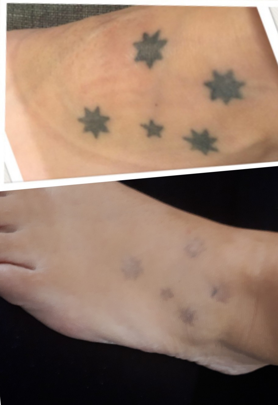 Extinct Ink Laser Treatments | store | 29 Caspian Circuit, Point Cook VIC 3030, Australia | 0405518020 OR +61 405 518 020