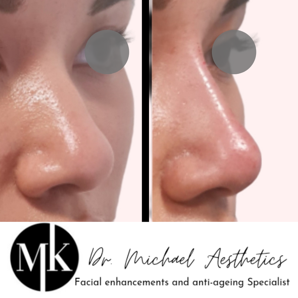 Non-surgical Rhinoplasty North Sydney | doctor | 46 Hercules St, Chatswood NSW 2067, Australia | 0280413293 OR +61 2 8041 3293