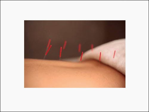 Nicholas Acupuncture | 81 Ringrose St, Brisbane City QLD 4053, Australia | Phone: 0421 043 360