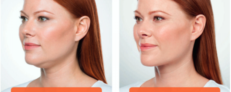 Refresh Skin Clinic | health | 1 Apsley St, Strathfieldsaye VIC 3551, Australia | 1300663393 OR +61 1300 663 393