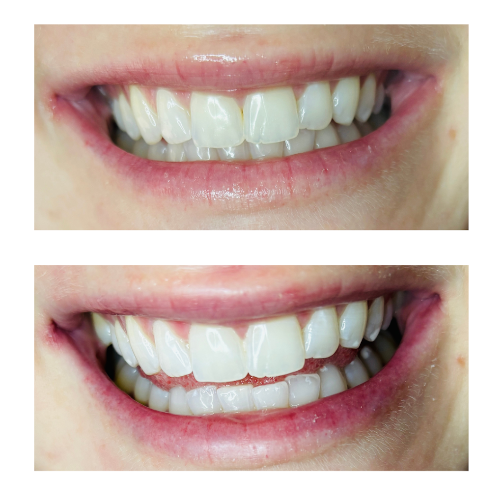The Whitening Room | MacDougall Rd, Golden Gully VIC 3555, Australia | Phone: 0426 284 861