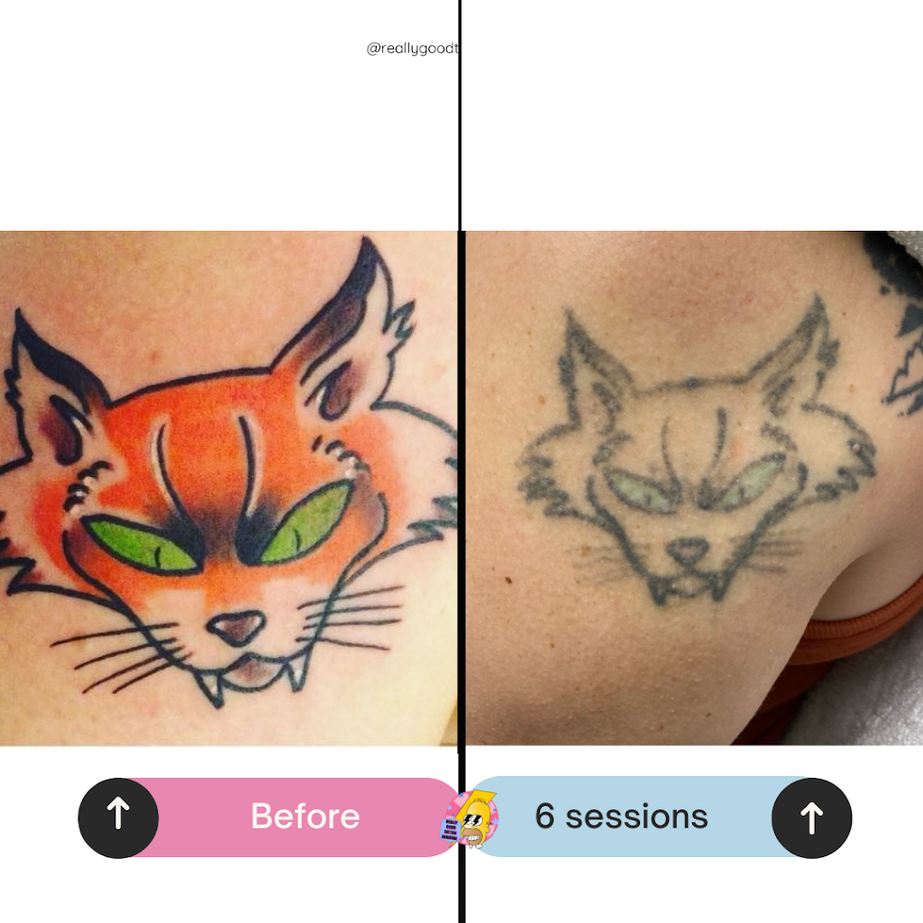 Really Good Tattoo Removal | 47 Clayton St, Sandgate QLD 4017, Australia | Phone: 0413 006 477