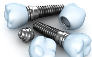 Dental Implant Professionals | dentist | Ground Floor, 350 Collins St, Melbourne VIC 3000, Australia | 1300320881 OR +61 1300 320 881