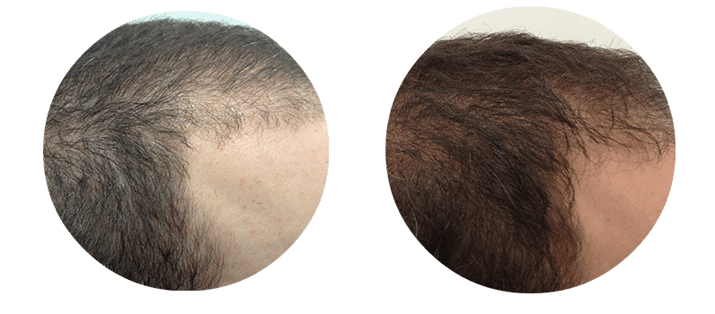 Fierce Hair Growth - Frankston | 149 Beach St, Frankston VIC 3199, Australia | Phone: 1300 343 723