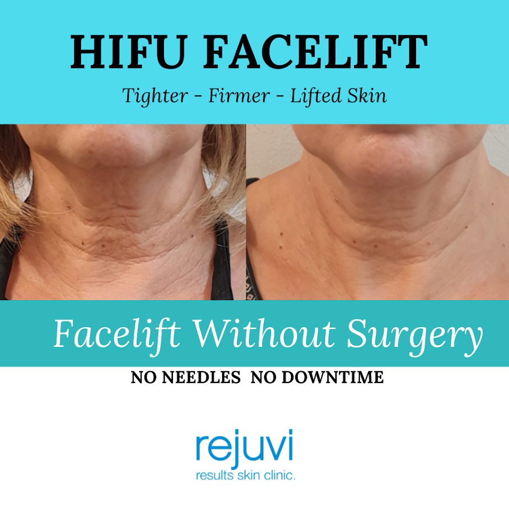 Rejuvi Results Skin Clinic | BY APPOINTMENT ONLY, 34 Dovercourt Rd, Toowong QLD 4066, Australia | Phone: 0403 506 642