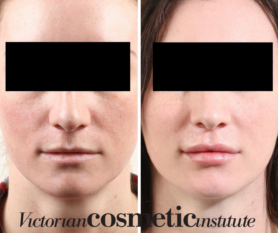 Victorian Cosmetic Institute Beaumaris | 1, 7-9 N Concourse, Beaumaris VIC 3193, Australia | Phone: 1300 863 824