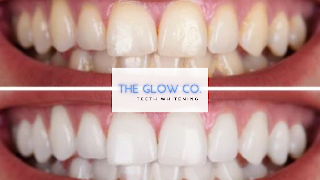 The Glow Co. Teeth Whitening | dentist | 13 Melrose Terrace, Somerville VIC 3912, Australia | 0419543358 OR +61 419 543 358