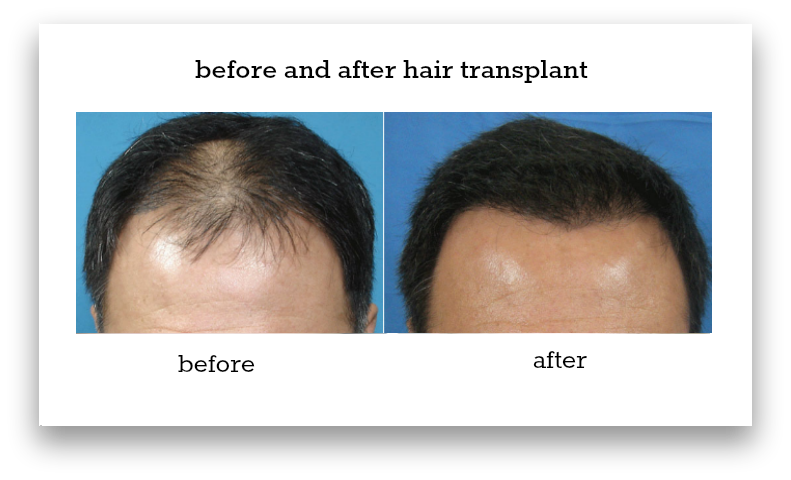 Sydney Hair Transplant | G04W, 138 Carillon Ave, Newtown NSW 2042, Australia | Phone: 1300 656 236
