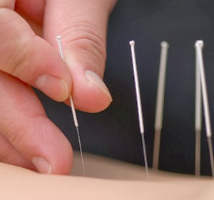 Seong Cheah Acupuncture | 2/22-26 Herbert St, West Ryde NSW 2114, Australia | Phone: (02) 9808 5948