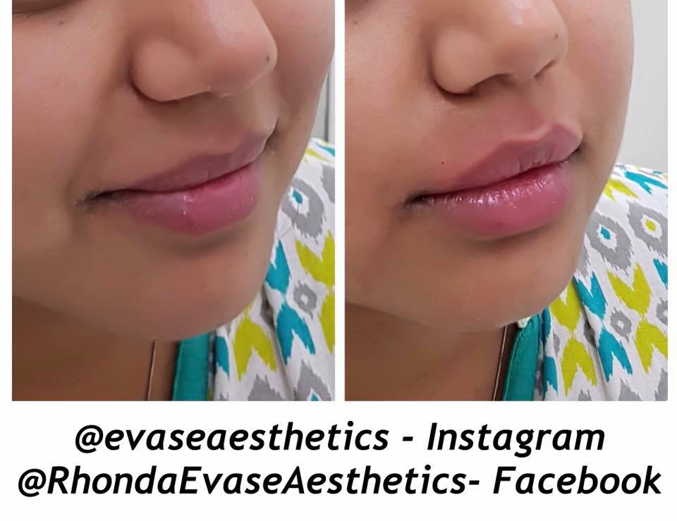EVASE Aesthetics | beauty salon | 20 MacDonald St, Dysart QLD 4745, Australia | 0400490205 OR +61 400 490 205