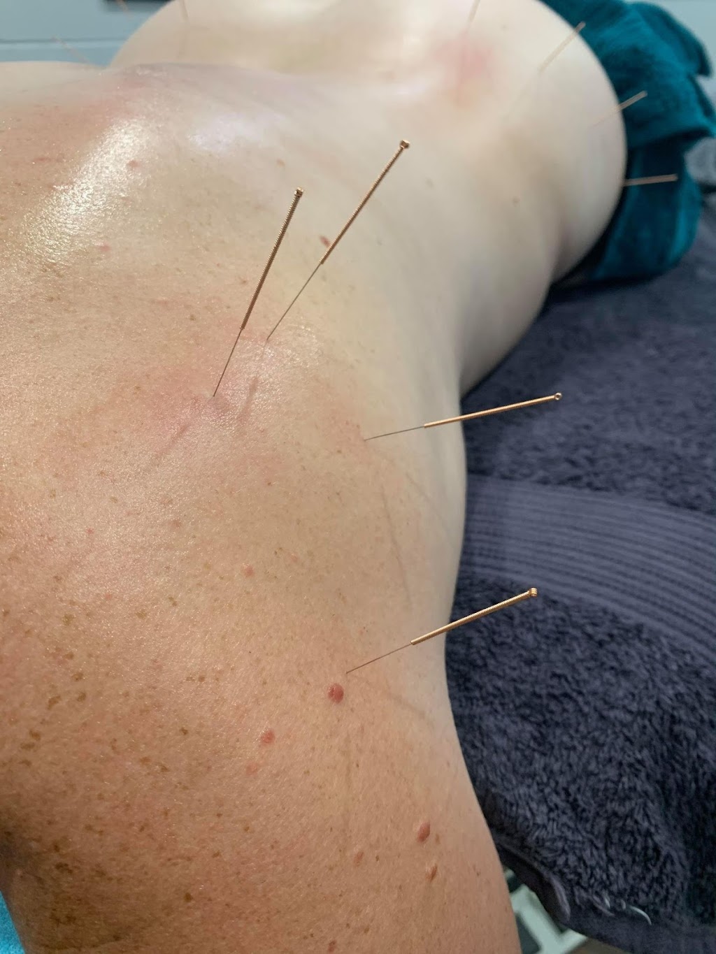 Pin Point Remedial Massage | 22 Clayton Rd, Lammermoor QLD 4703, Australia | Phone: 0406 916 490