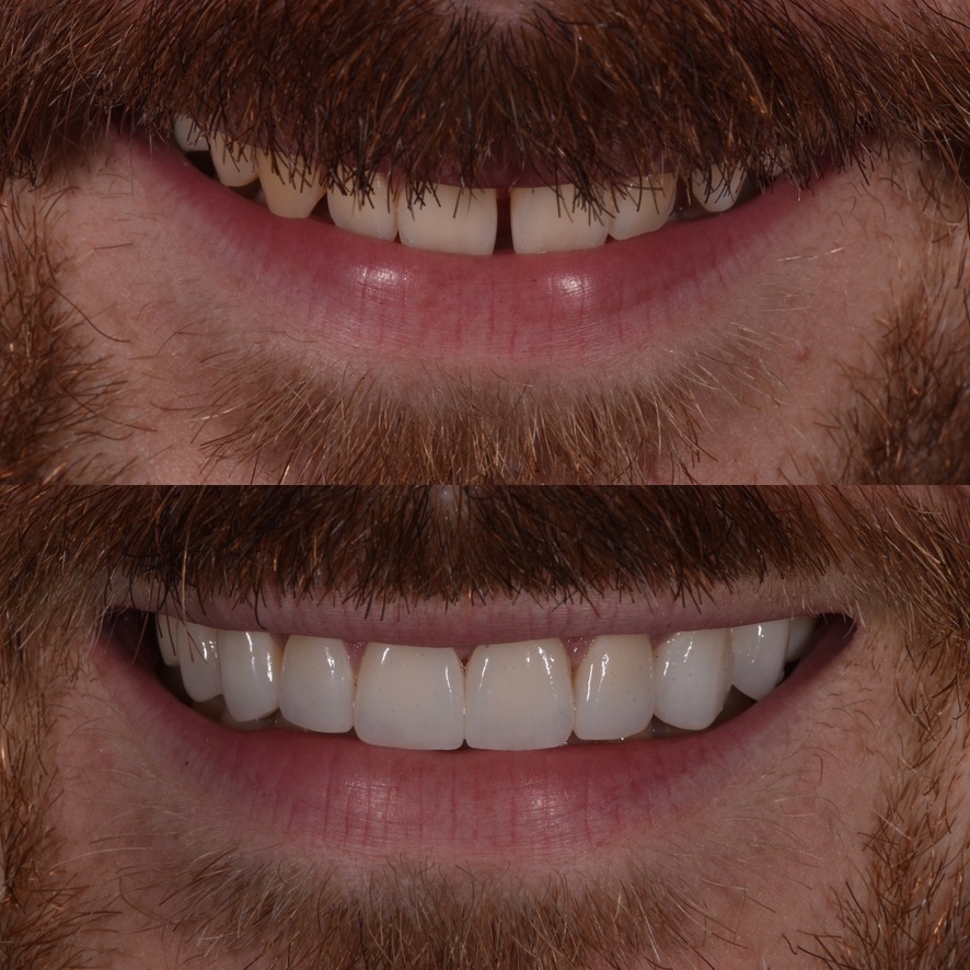 The Veneer Studio | 130 Nepean Hwy, Aspendale VIC 3195, Australia | Phone: 1300 314 473