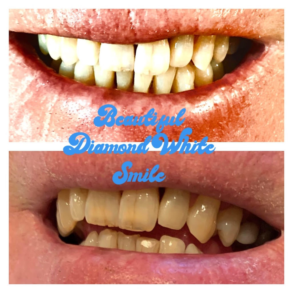 Diamond White Teeth Whitening | health | 171 Coxs Rd, North Ryde NSW 2113, Australia | 0424142848 OR +61 424 142 848