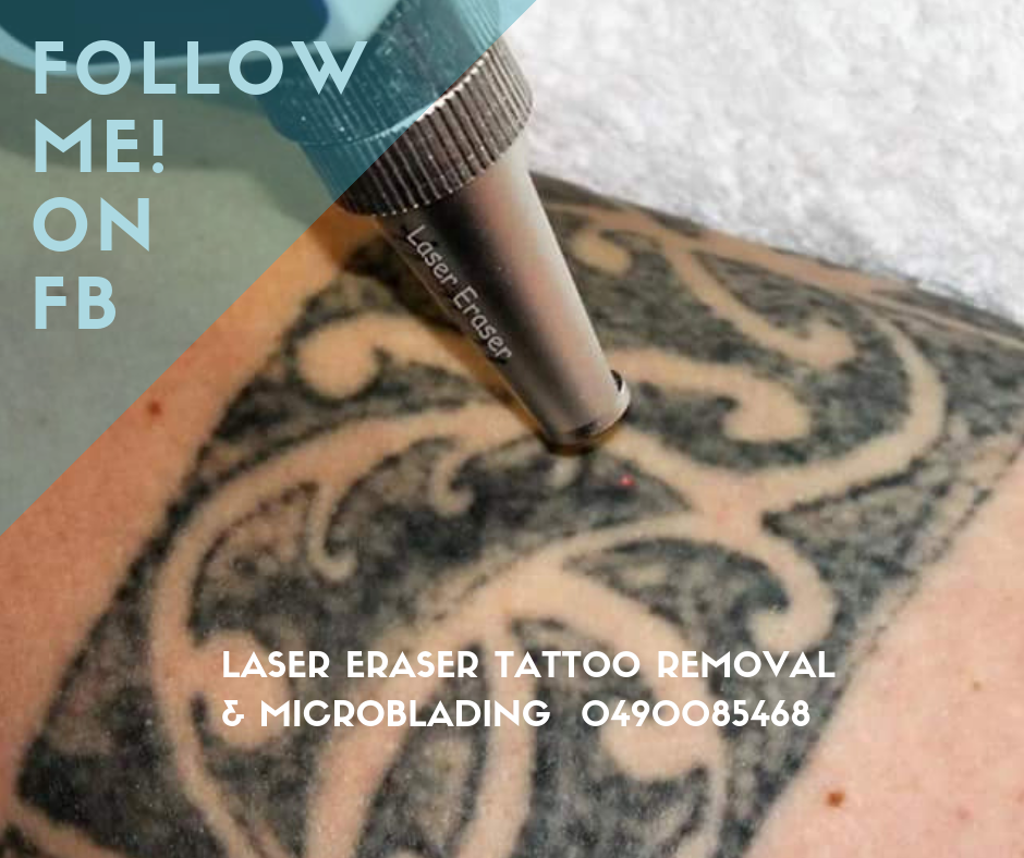 Laser Eraser Tattoo Removal & Beauty | 91 Cobbora Rd, Dubbo NSW 2830, Australia | Phone: 0490 085 468