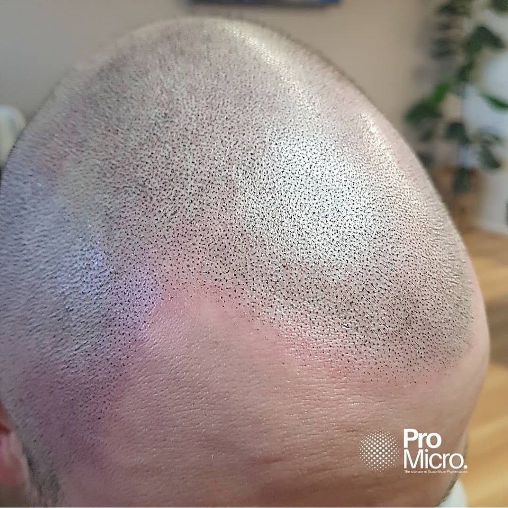 Pro Micro - Scalp Micropigmentation SMP | 23/58 Riverwalk Ave, Robina QLD 4226, Australia | Phone: 0437 778 852