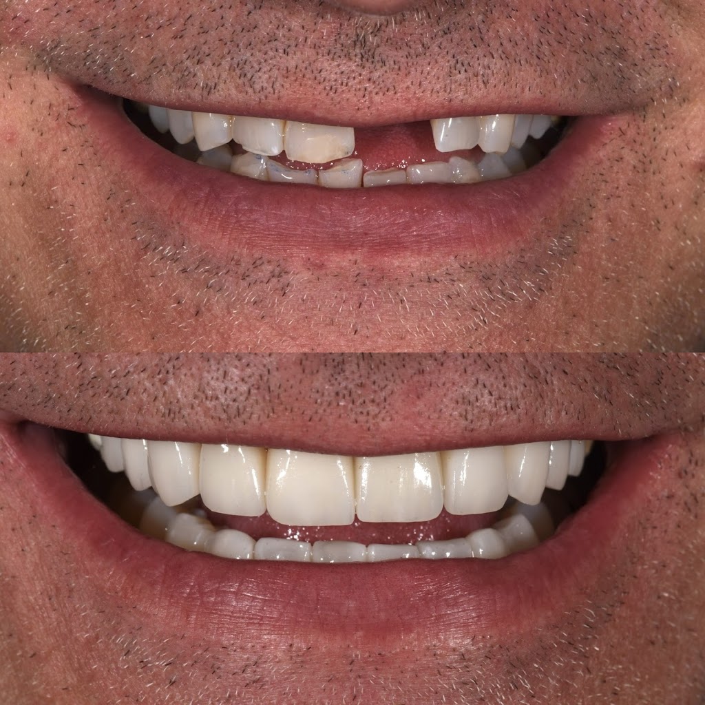The Veneer Studio | 130 Nepean Hwy, Aspendale VIC 3195, Australia | Phone: 1300 314 473