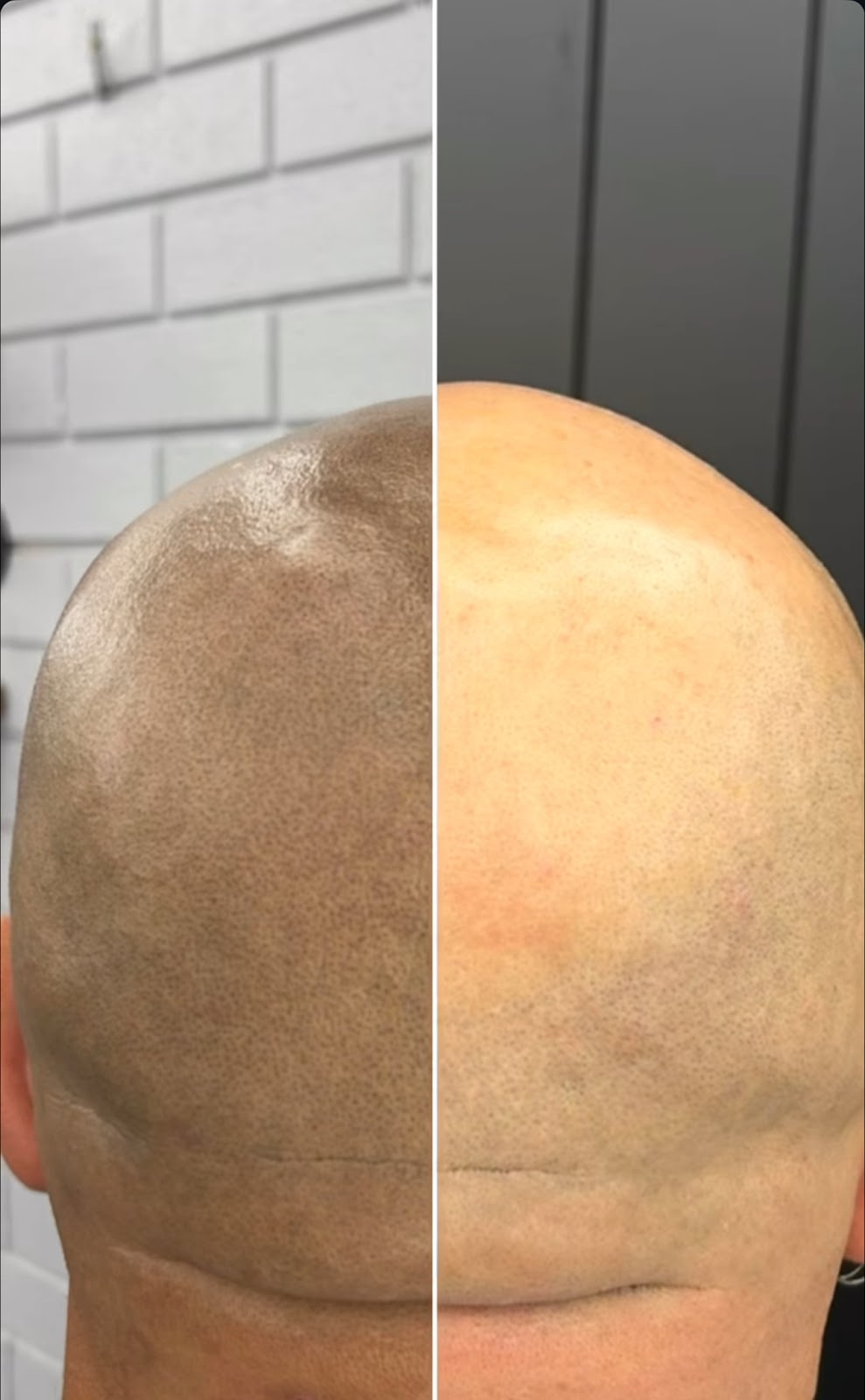 Scalp It SMP Hair Clinic | 11 - 13 Main St, Mount Annan NSW 2567, Australia | Phone: 0405 222 339