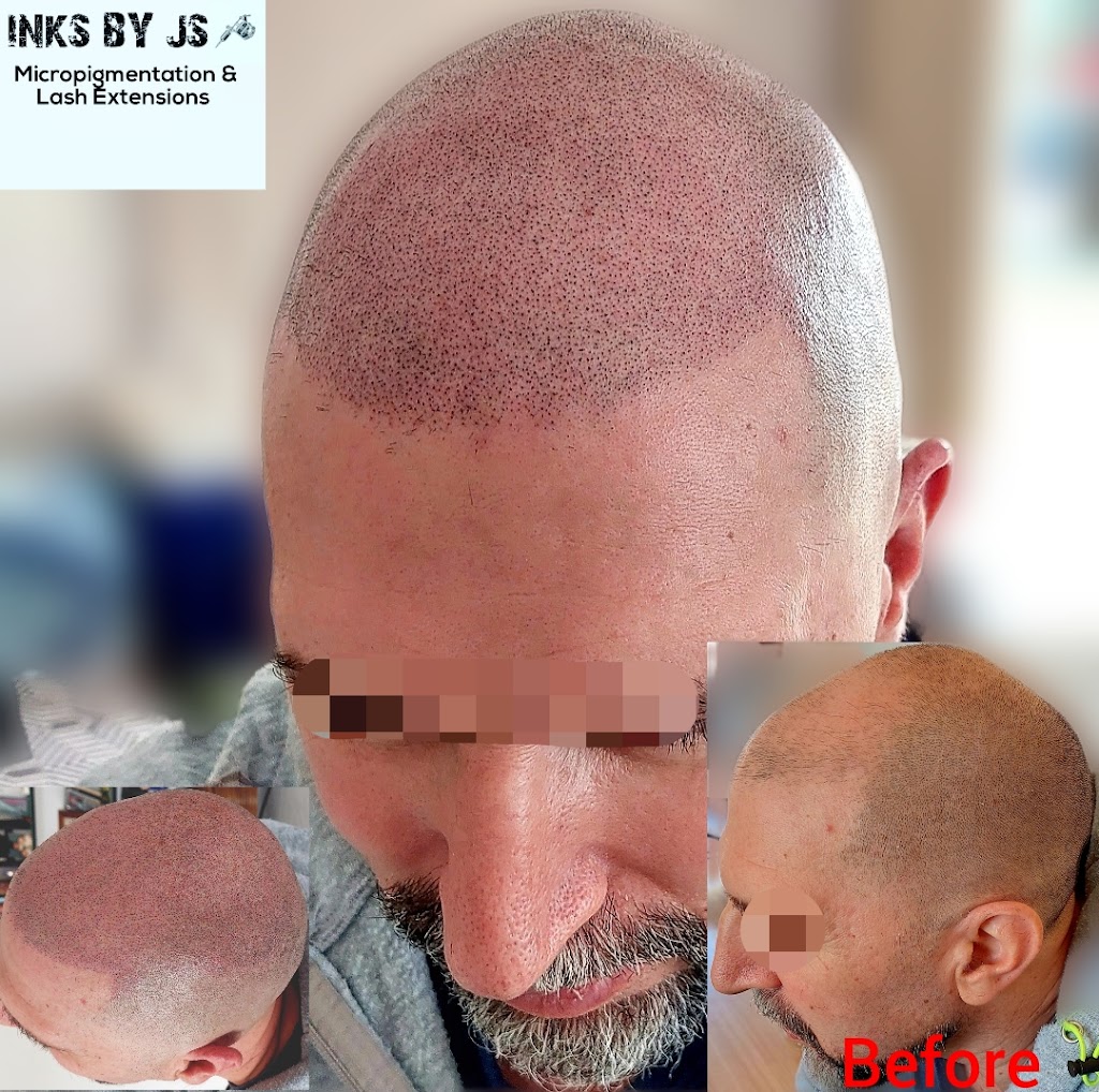 Scalp Micropigmentation SMP Melbourne Inks by JS | hair care | Sayers Rd, Tarneit VIC 3029, Australia | 0421844551 OR +61 421 844 551