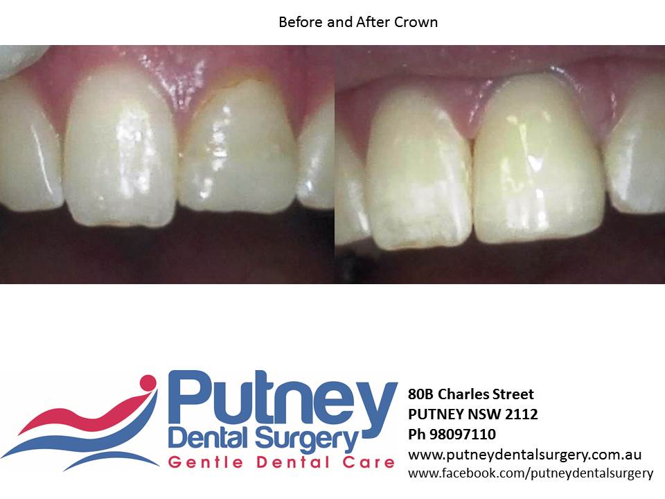 Putney Dental Surgery | dentist | 80B Charles St, Putney NSW 2112, Australia | 0298097110 OR +61 2 9809 7110