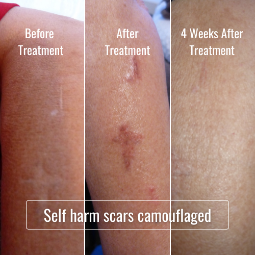 Scar Camouflage by Sue Savage | 31 Royal Terrace, Royal Park SA 5014, Australia | Phone: (08) 8341 0695