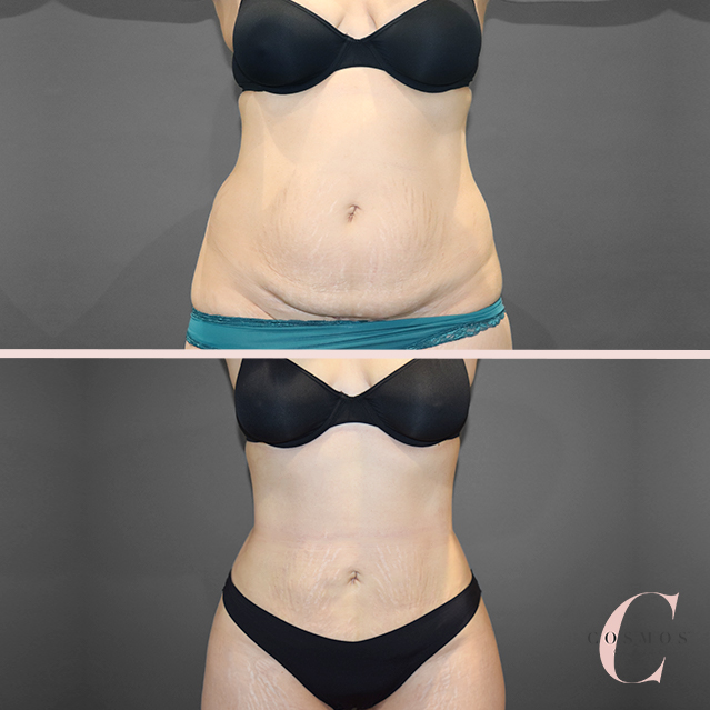Cosmos Clinic - Leaders in Liposuction | doctor | 10 Henrietta St, Double Bay NSW 2028, Australia | 1300138797 OR +61 1300 138 797