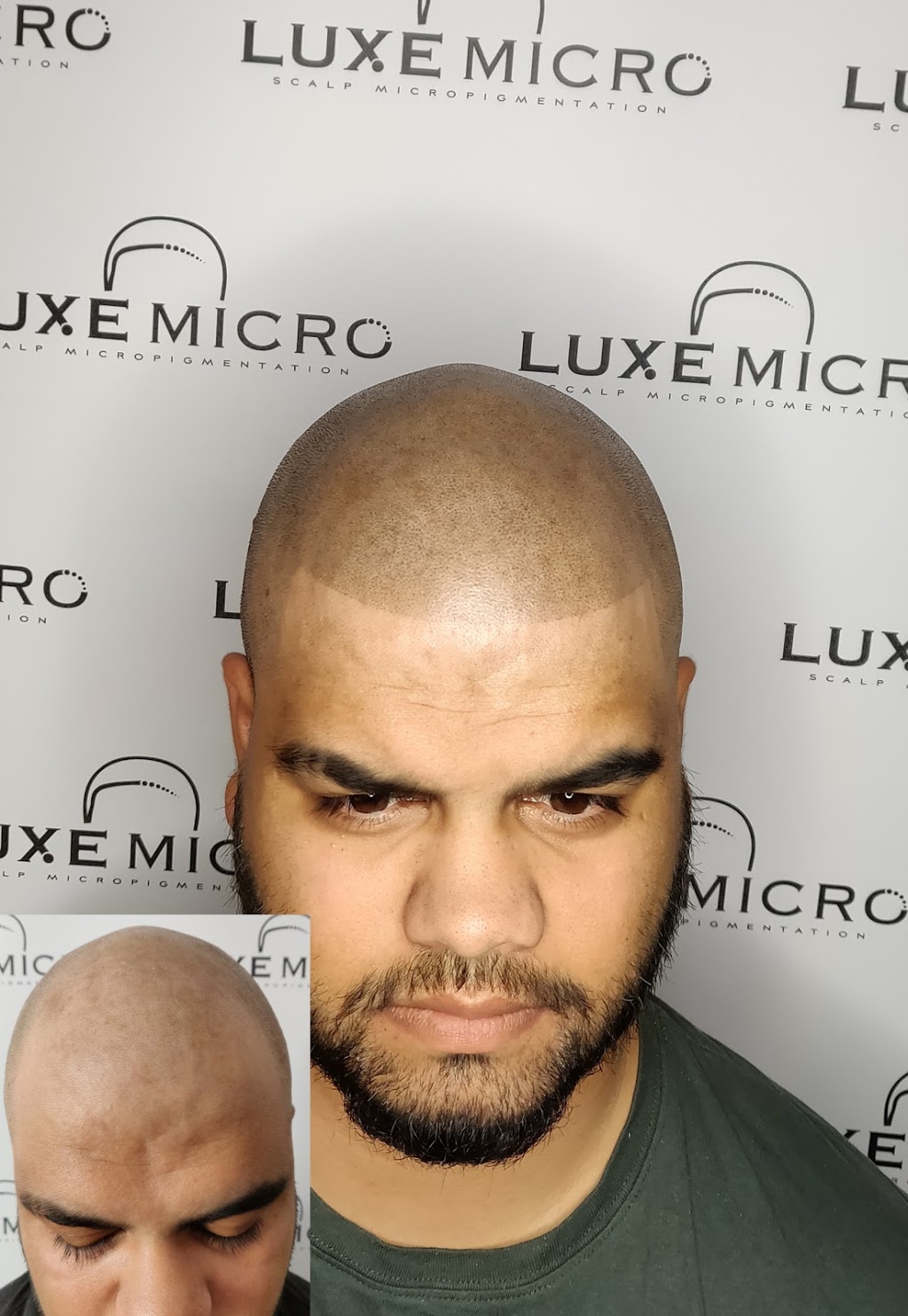 Luxe Micro, Scalp Micropigmentation Melbourne | hair care | 14 Ellaroo Circuit, Clyde North VIC 3978, Australia | 0451273940 OR +61 451 273 940