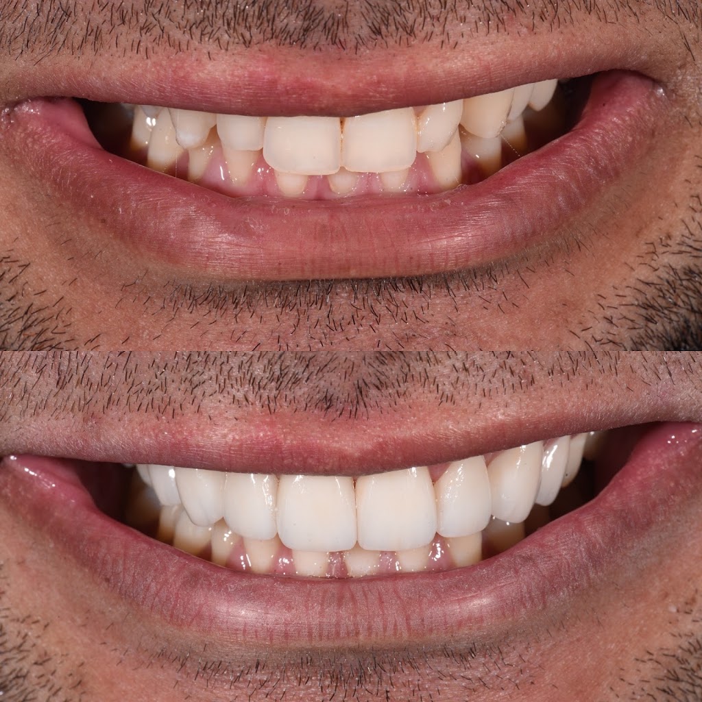 The Veneer Studio | 130 Nepean Hwy, Aspendale VIC 3195, Australia | Phone: 1300 314 473