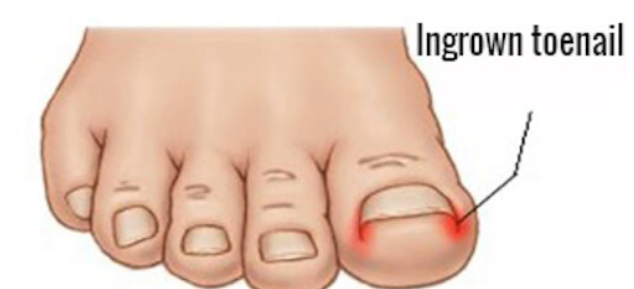 Canberra Ingrown Toenail Clinic | doctor | 140 Anketell St, Greenway ACT 2900, Australia | 0262932024 OR +61 2 6293 2024