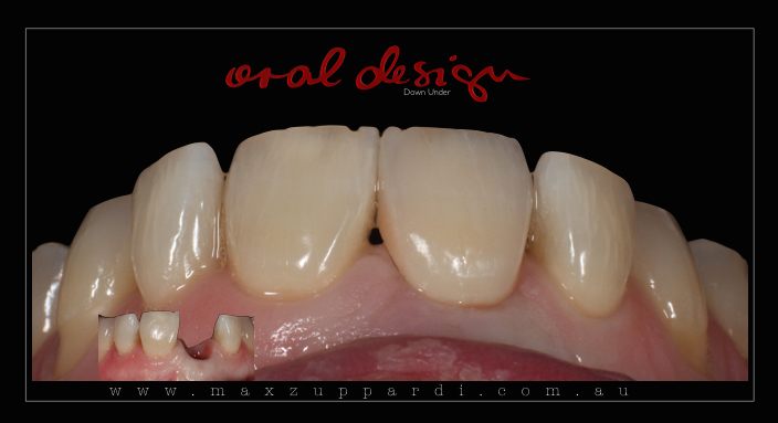 Max Zuppardi - Oral Design Down Under | dentist | Suite 5/701 Military Rd, Mosman NSW 2088, Australia | 0280847525 OR +61 2 8084 7525