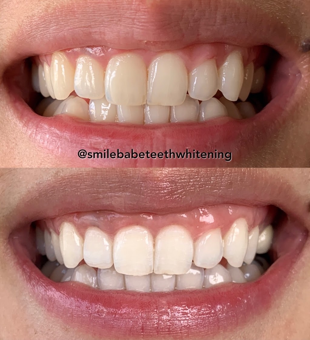 Smile Babe Teeth Whitening | dentist | 68 Cathedral Rocks Ave, Kiama Downs NSW 2533, Australia | 0423043736 OR +61 423 043 736