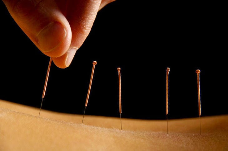 Kylie Stabler Acupuncture | 7 Blyth St, Brunswick VIC 3056, Australia | Phone: 0415 607 986