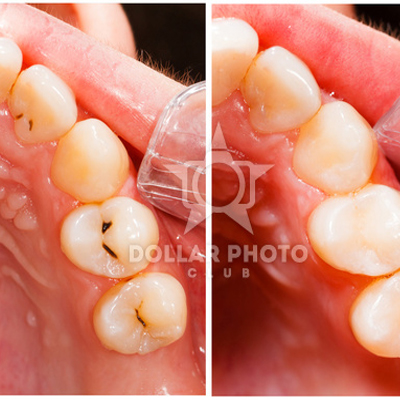 My Smile Dental - Sydenham | dentist | 518 Melton Hwy, Hillside VIC 3037, Australia | 0393909333 OR +61 3 9390 9333
