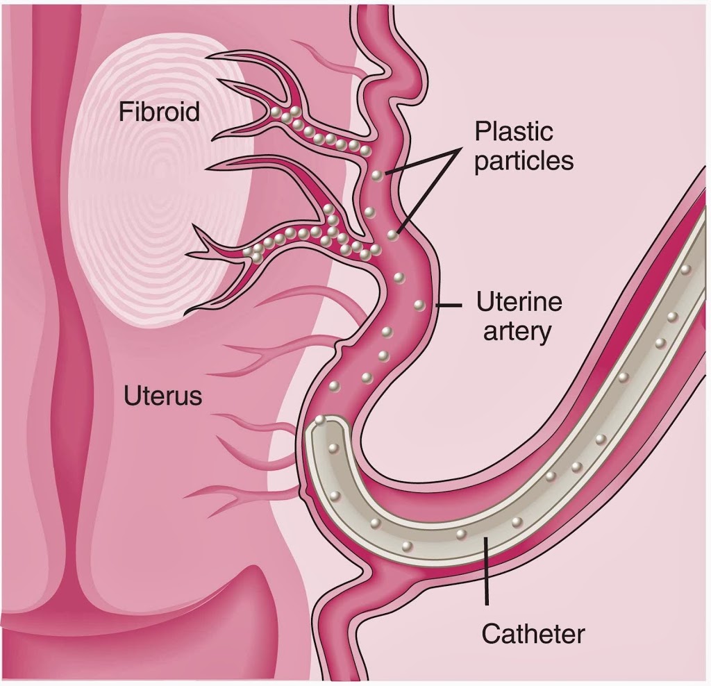 Sydney Fibroid Clinic (Wahroonga) | Suite 407, San Clinic, 185 Fox Valley Rd, Wahroonga NSW 2076, Australia | Phone: (02) 9473 8728