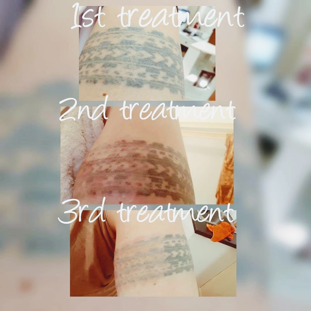 Tattoo removal and beauty services lismore | beauty salon | Fletcher street, Goonellabah NSW 2480, Australia | 0423240976 OR +61 423 240 976