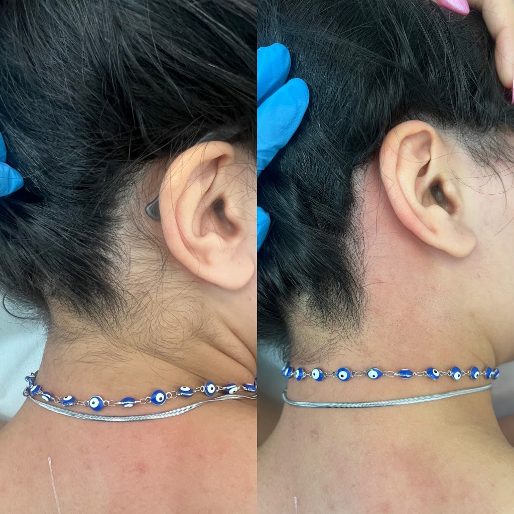 Laser By Zara | 1 Inverness Cct, Cecil Hills NSW 2171, Australia | Phone: 0420 770 846