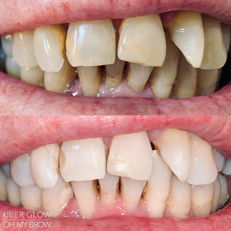 The Teeth Whitenin Co - Glenelg | dentist | 34 Ulinga St, Glenelg North SA 5045, Australia | 0401047857 OR +61 401 047 857