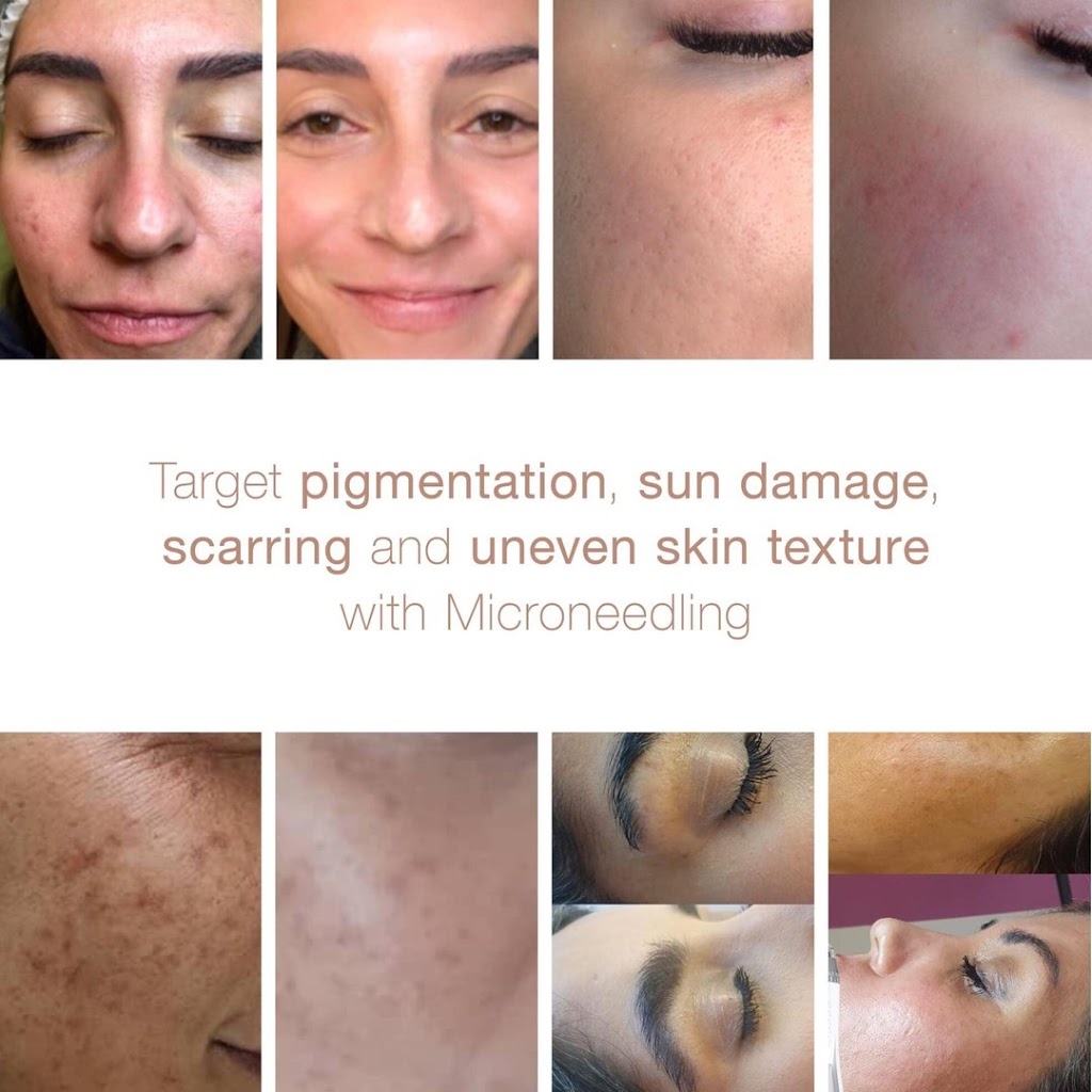 Focus Skin and Laser | 28 Hackman St, McDowall QLD 4053, Australia | Phone: 0475 074 355