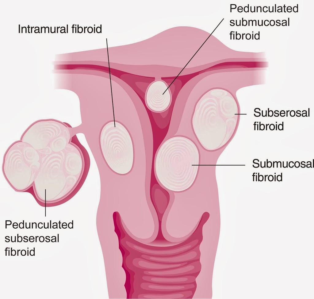 Sydney Fibroid Clinic (Wahroonga) | Suite 407, San Clinic, 185 Fox Valley Rd, Wahroonga NSW 2076, Australia | Phone: (02) 9473 8728