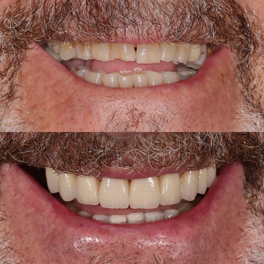 The Veneer Studio | 130 Nepean Hwy, Aspendale VIC 3195, Australia | Phone: 1300 314 473