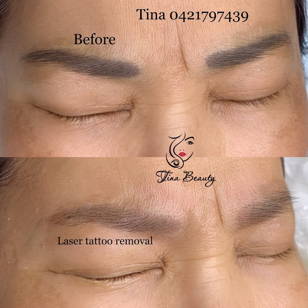 Melbourne Laser Eyebrows Tattoo Removal | beauty salon | 68 Spring Rd, Springvale South VIC 3172, Australia | 0403816410 OR +61 403 816 410