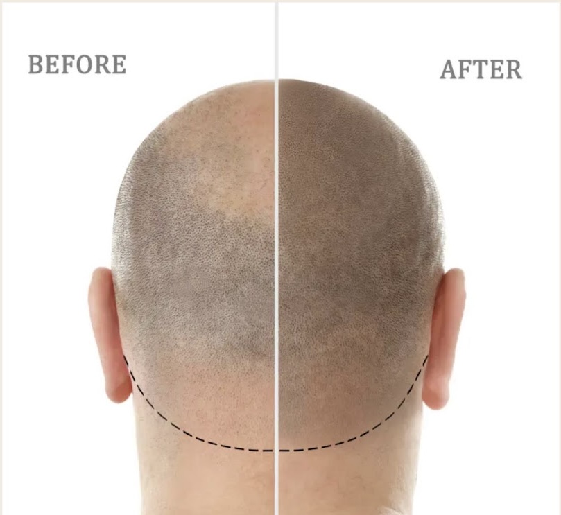 Scalp It SMP Hair Clinic | 11 - 13 Main St, Mount Annan NSW 2567, Australia | Phone: 0405 222 339