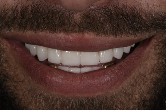 The Veneer Studio | 130 Nepean Hwy, Aspendale VIC 3195, Australia | Phone: 1300 314 473