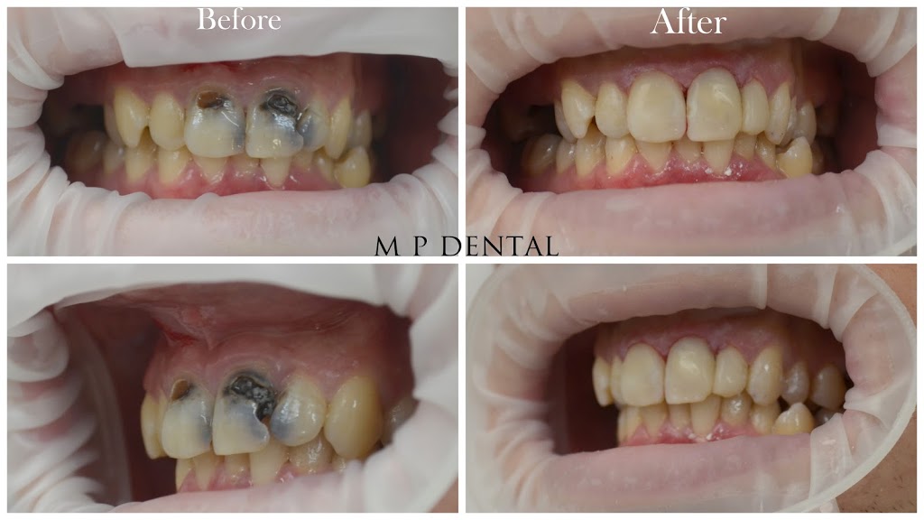 MP Dental Wangaratta | dentist | 47-51 Joyce Way, Wangaratta VIC 3677, Australia | 1800433682 OR +61 1800 433 682